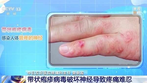 巨疼, 发病前期会传染! 过度劳累、熬夜或引起这种病